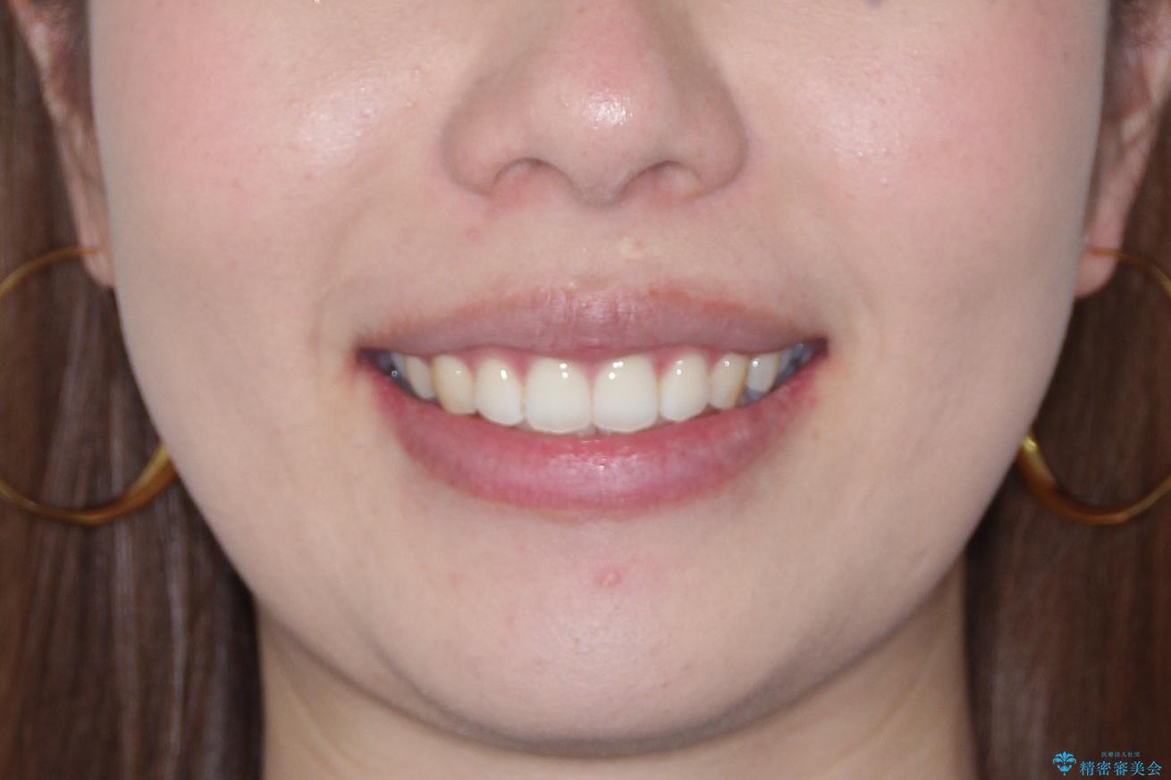 【前歯のガタガタが気になる】インビザライン症例の治療後(顔貌)