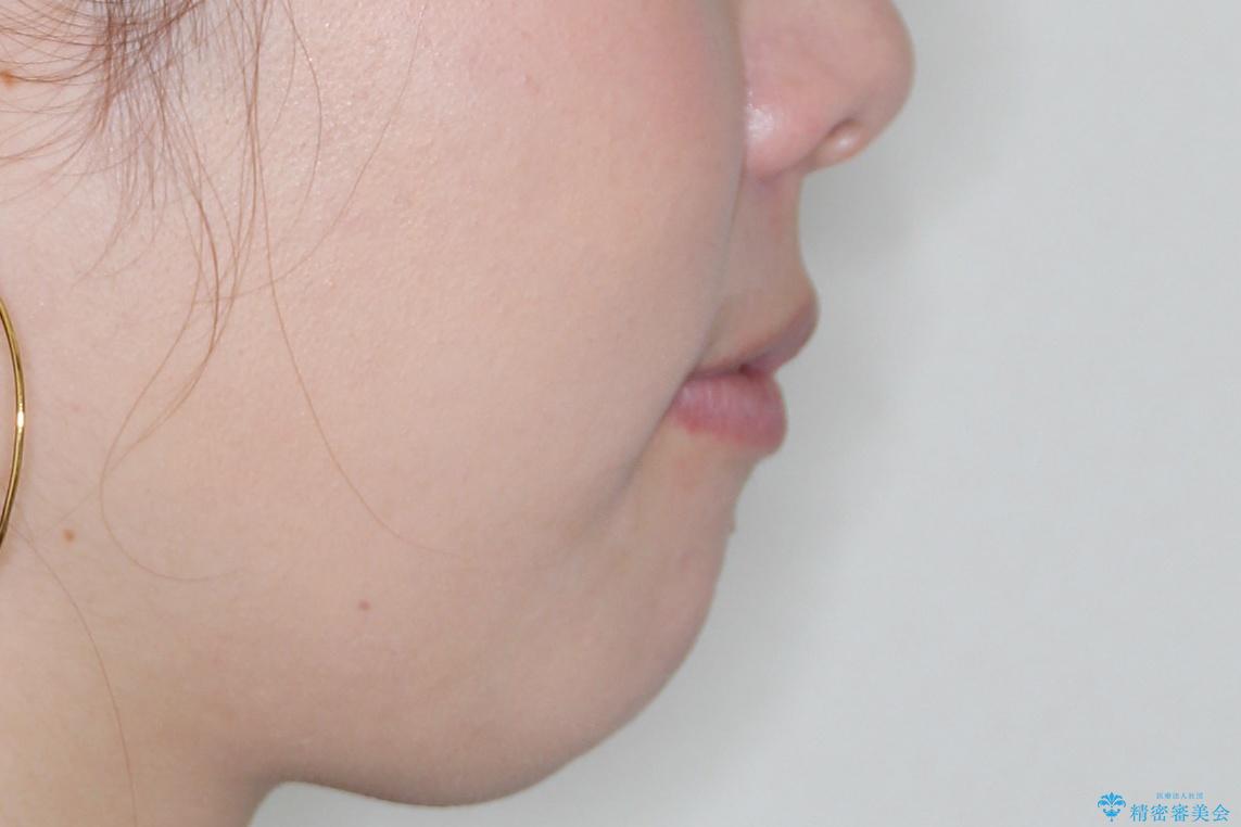 【前歯のガタガタが気になる】インビザライン症例の治療後(顔貌)