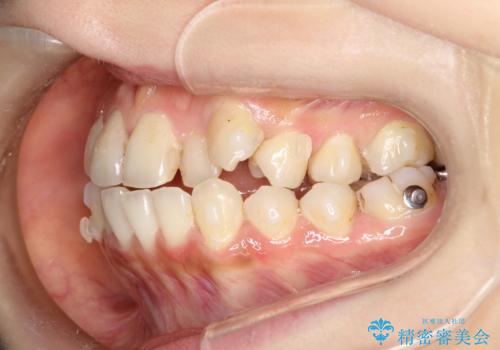 八重歯をインビザラインで非抜歯矯正の治療中