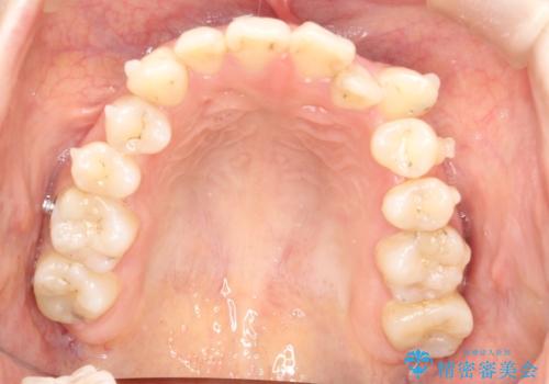 八重歯をインビザラインで非抜歯矯正の治療中