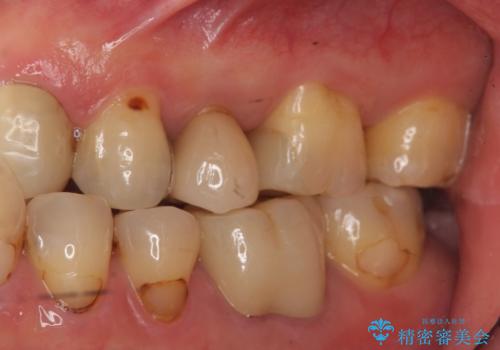 銀の詰め物をやりかえたいの治療前
