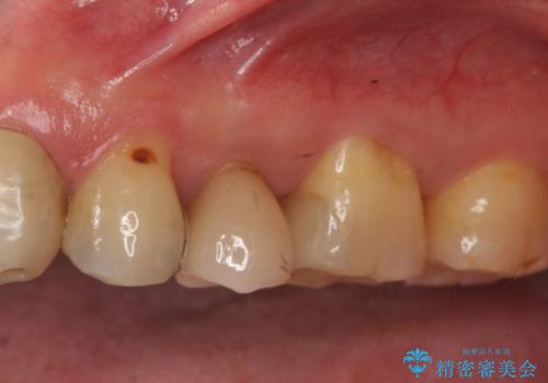 銀の詰め物をやりかえたいの治療前