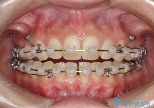 出っ歯で口が閉じずらい　ワイヤーによる抜歯矯正の治療中