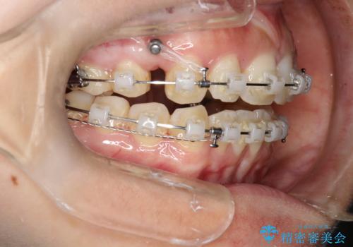 出っ歯で口が閉じずらい　ワイヤーによる抜歯矯正の治療中