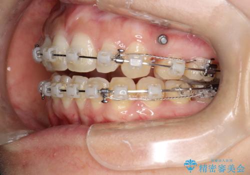 出っ歯で口が閉じずらい ワイヤーによる抜歯矯正の治療中