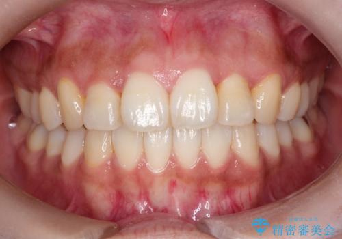 【引っ込んだ前歯が気になる、真ん中の線も揃えたい】インビザライン症例の症例 治療後