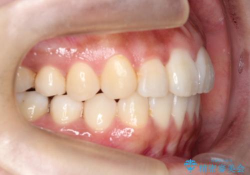 【引っ込んだ前歯が気になる、真ん中の線も揃えたい】インビザライン症例の治療後