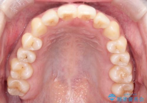 【引っ込んだ前歯が気になる、真ん中の線も揃えたい】インビザライン症例の治療後
