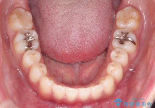 【引っ込んだ前歯が気になる、真ん中の線も揃えたい】インビザライン症例の治療後
