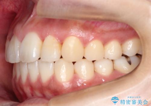 【引っ込んだ前歯が気になる、真ん中の線も揃えたい】インビザライン症例の治療後