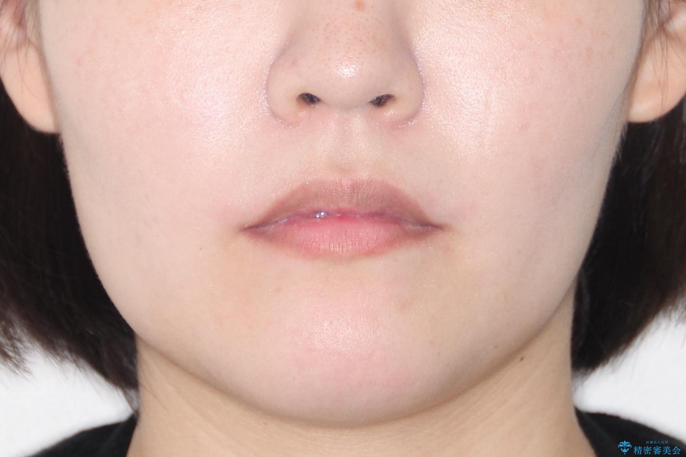 【引っ込んだ前歯が気になる、真ん中の線も揃えたい】インビザライン症例の治療後(顔貌)