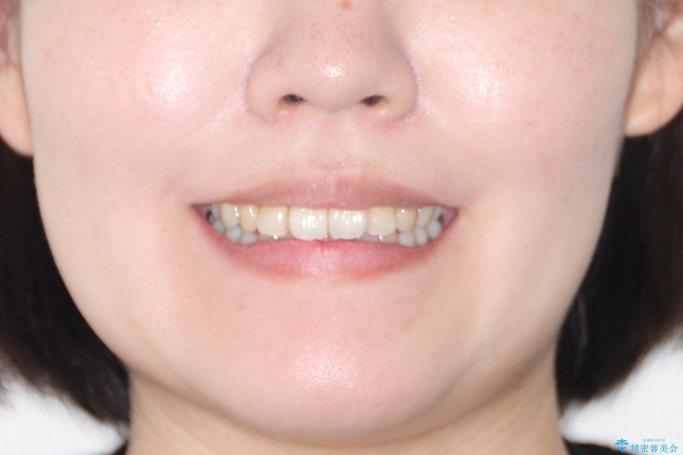 【引っ込んだ前歯が気になる、真ん中の線も揃えたい】インビザライン症例の治療後（顔貌）