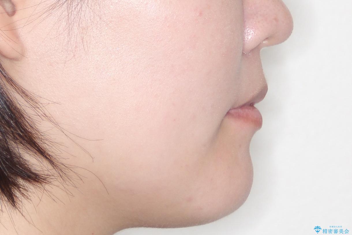 【引っ込んだ前歯が気になる、真ん中の線も揃えたい】インビザライン症例の治療後(顔貌)