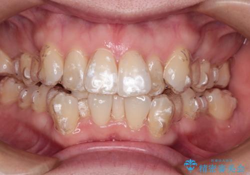 【抜歯ケース】前歯のガタガタをインビザラインで治療の治療中
