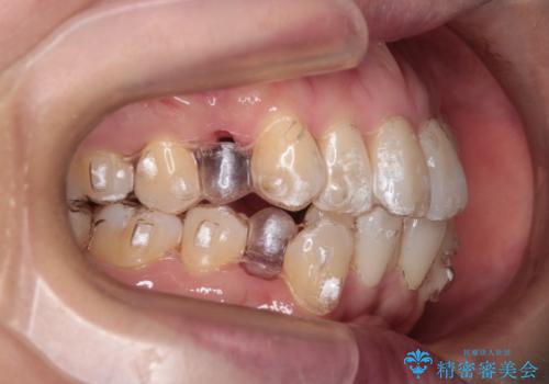 【抜歯ケース】前歯のガタガタをインビザラインで治療の治療中