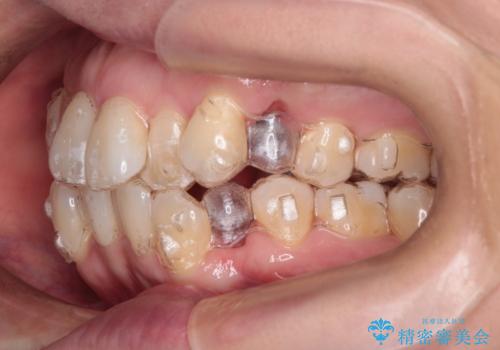 【抜歯ケース】前歯のガタガタをインビザラインで治療の治療中