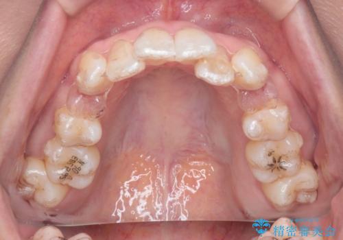 【抜歯ケース】前歯のガタガタをインビザラインで治療の治療中