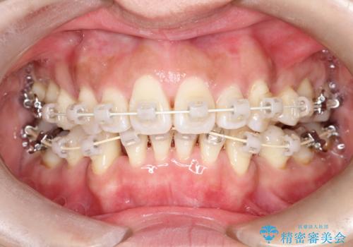 出っ歯で口が閉じずらい　ワイヤー抜歯矯正の治療中