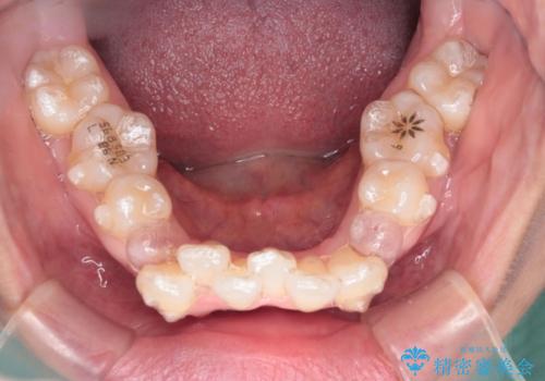 【抜歯ケース】前歯のガタガタをインビザラインで治療の治療中