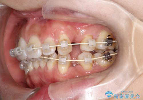 出っ歯で口が閉じずらい ワイヤー抜歯矯正の治療中