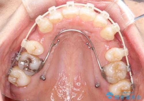 出っ歯で口が閉じずらい　ワイヤー抜歯矯正の治療中
