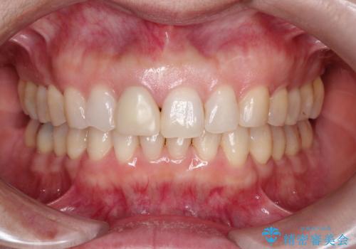 【オールセラミッククラウン】他院で入れた被せものがすぐとれるの治療前