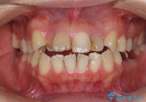 八重歯と開咬を治したい　目立たないハーフリンガル矯正の治療前