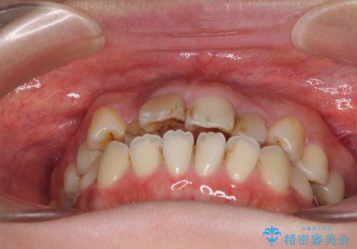 八重歯と開咬を治したい 目立たないハーフリンガル矯正の治療前