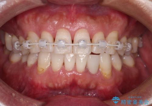 内側にある歯が干渉する 上顎前歯の部分矯正の治療中