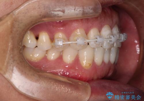 内側にある歯が干渉する 上顎前歯の部分矯正の治療中