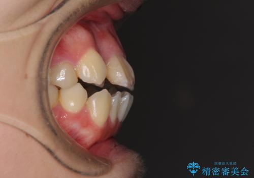 八重歯と開咬を治したい 目立たないハーフリンガル矯正の治療前