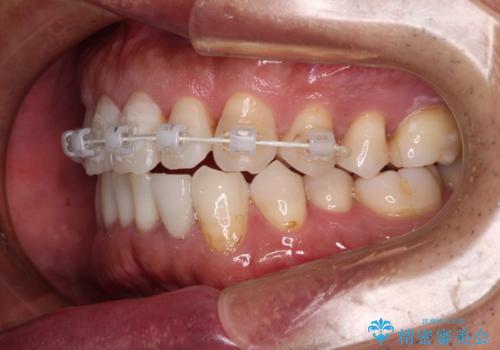 内側にある歯が干渉する 上顎前歯の部分矯正の治療中