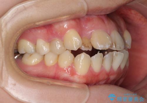 八重歯と開咬を治したい 目立たないハーフリンガル矯正の治療前