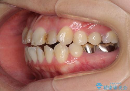 八重歯と開咬を治したい 目立たないハーフリンガル矯正の治療前