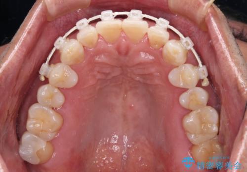 内側にある歯が干渉する　上顎前歯の部分矯正の治療中