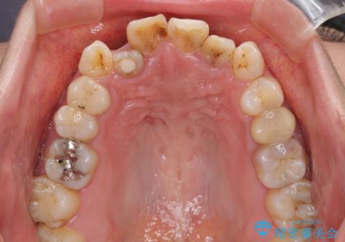 八重歯と開咬を治したい 目立たないハーフリンガル矯正の治療前