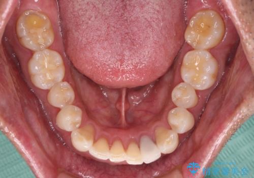 内側にある歯が干渉する 上顎前歯の部分矯正の治療中