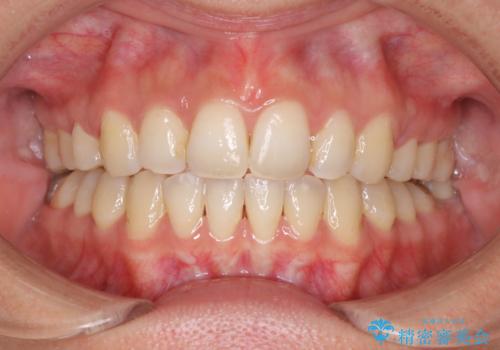出っ歯で口が閉じずらい　ワイヤーによる抜歯矯正の治療後