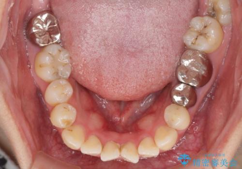 八重歯と開咬を治したい　目立たないハーフリンガル矯正の治療前