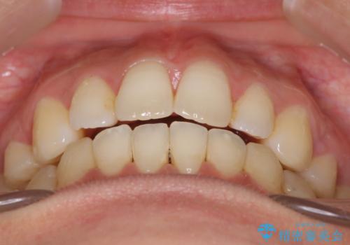 出っ歯で口が閉じずらい ワイヤーによる抜歯矯正の治療後