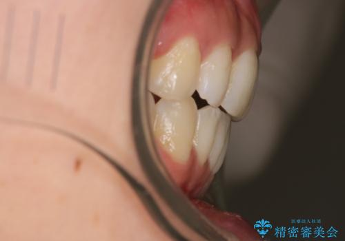 出っ歯で口が閉じずらい ワイヤーによる抜歯矯正の治療後