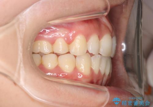出っ歯で口が閉じずらい　ワイヤーによる抜歯矯正の治療後