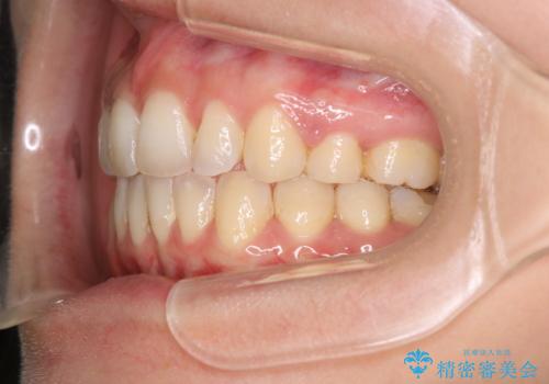 出っ歯で口が閉じずらい ワイヤーによる抜歯矯正の治療後