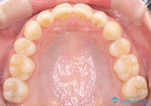 出っ歯で口が閉じずらい ワイヤーによる抜歯矯正の治療中