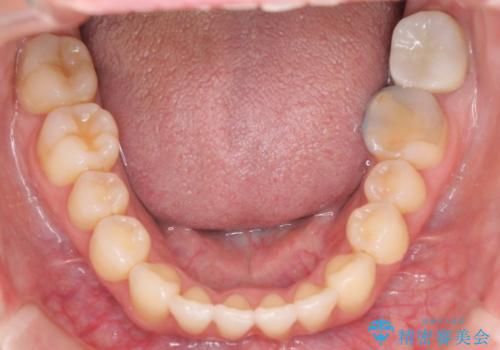 出っ歯で口が閉じずらい ワイヤーによる抜歯矯正の治療中