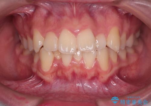 【インビザライン】前歯の凸凹を非抜歯で治療の症例 治療前