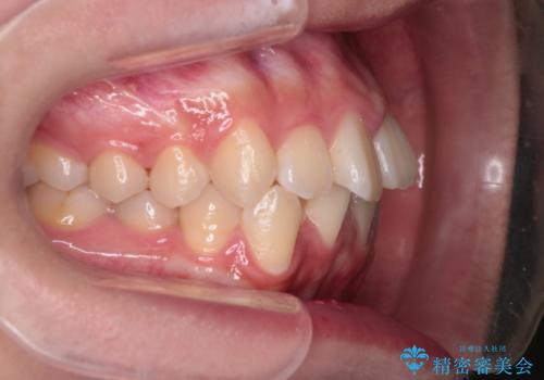 【インビザライン】前歯の凸凹を非抜歯で治療の治療前