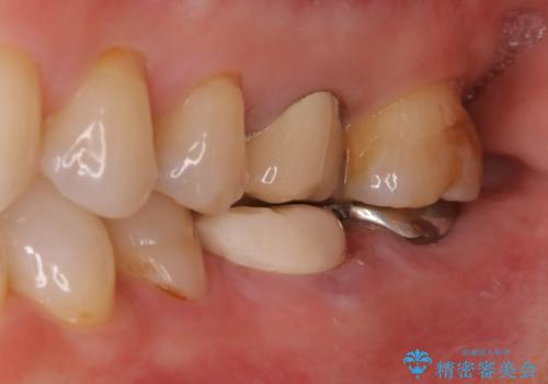 他院で仮歯までしたが、放置していたためセラミック入れたい セラミック治療の治療前