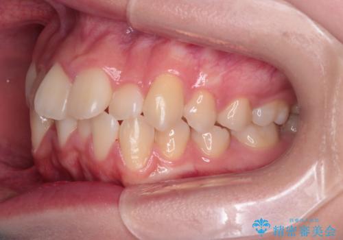 【インビザライン】前歯の凸凹を非抜歯で治療の治療前