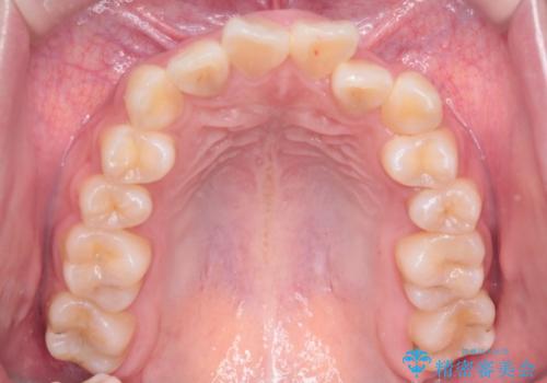 【インビザライン】前歯の凸凹を非抜歯で治療の治療前